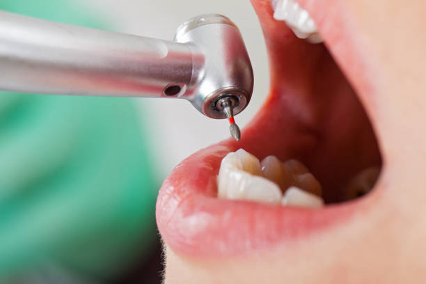Best Emergency Root Canal Treatment in Ladera Ranch, CA